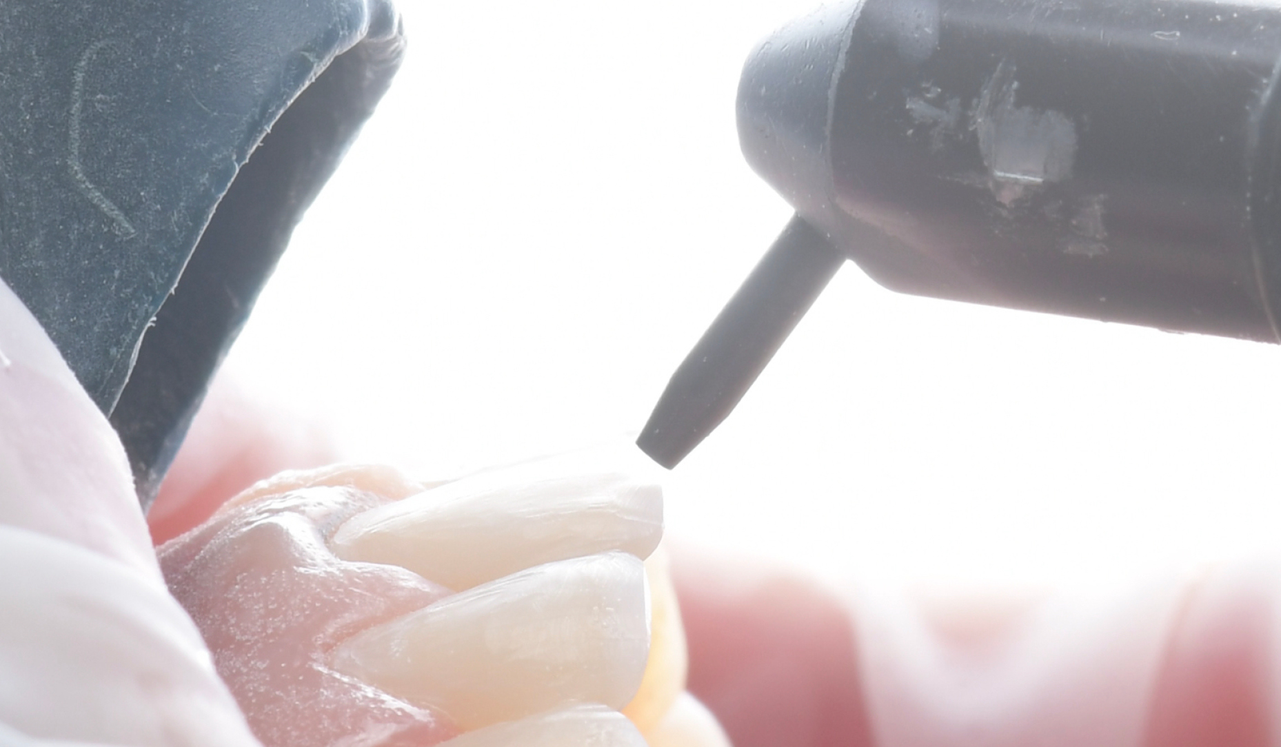 Figure 4: Air-abrasion with 27 μm aluminium oxide particles.